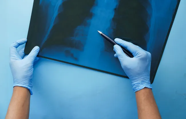 Cancer du poumon : un dispositif de télésurveillance à l’étude (MOOVCARE®) Institut Curie