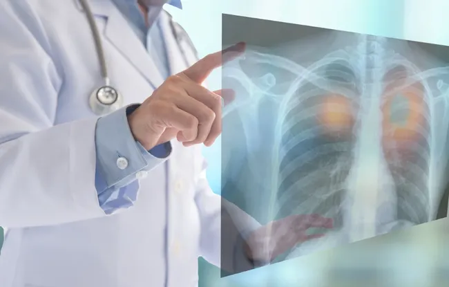 Cancer du poumon : l’oncologie adaptative au cœur des travaux de l’Institut Curie, pour une meilleure prise en charge des patients