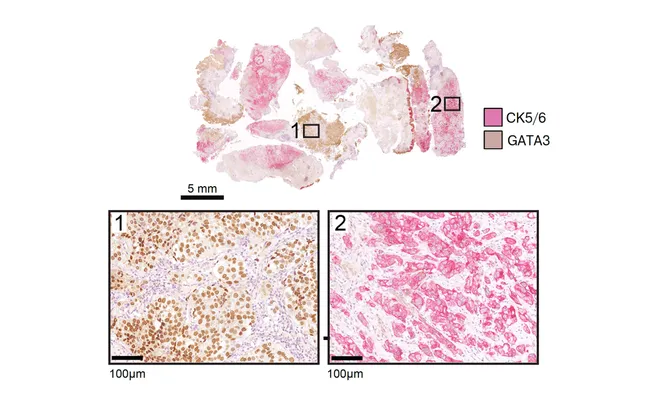 New data on the prognosis of different molecular subtypes of bladder cancer 