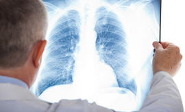 Image de radiographie du poumon